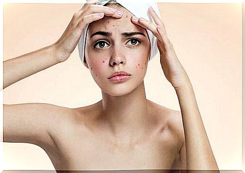 Tomato beauty products for acne