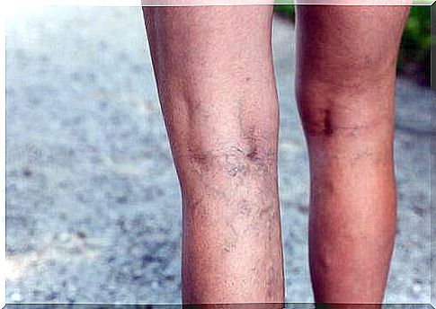 Tomato beauty products for varicose veins