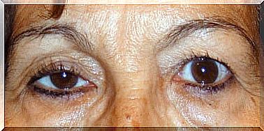 drooping eyelids as a sign of disease