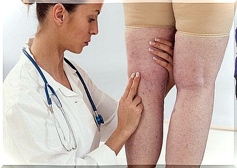 Benefits of gelatin: Reduction of swelling on the legs