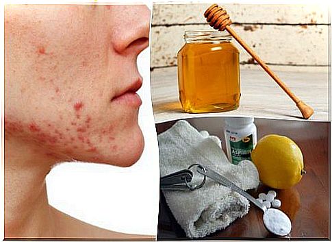 6 home remedies for cystic acne