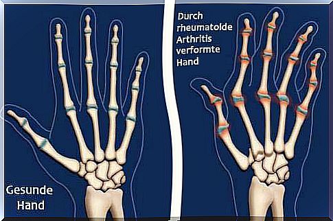 Arthritis illustration