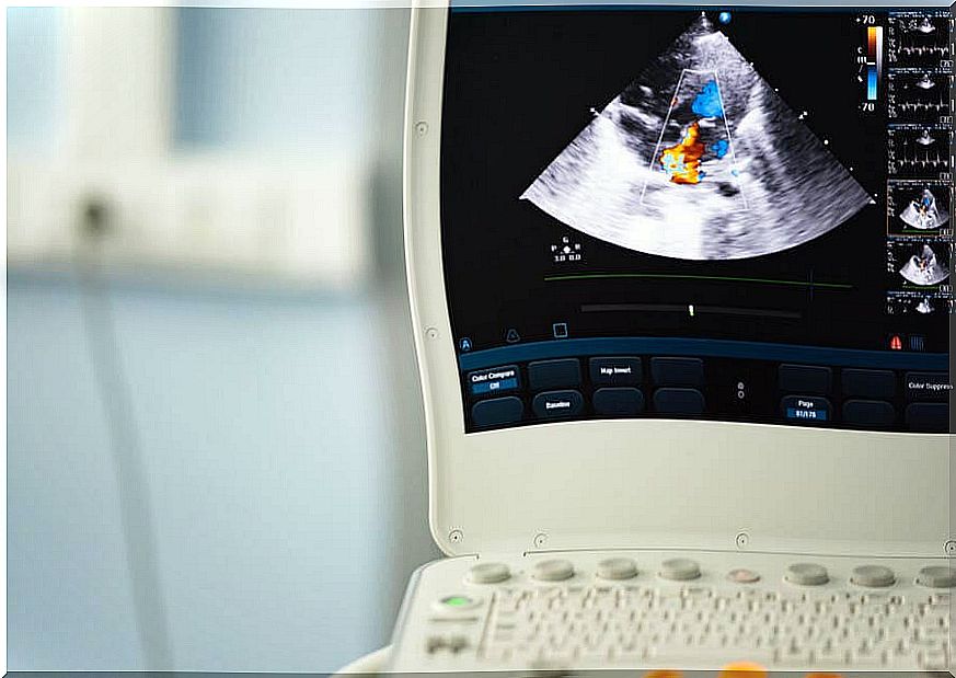 Bicuspid aortic valve: diagnosis and treatment