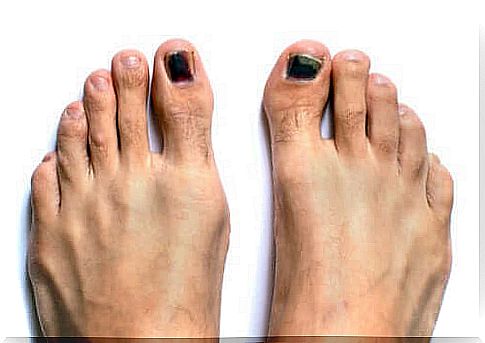 Black toenail: causes and treatment