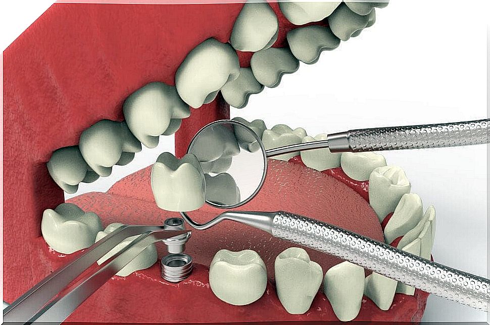 Illustration of a dental implant