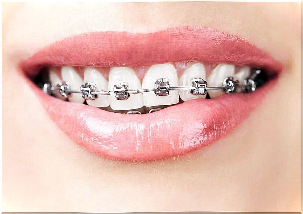 Woman smile with braces