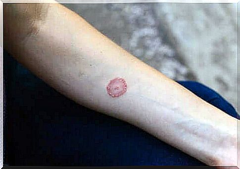 Pityriasis versicolor