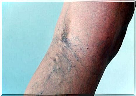 Spider veins and varicose veins