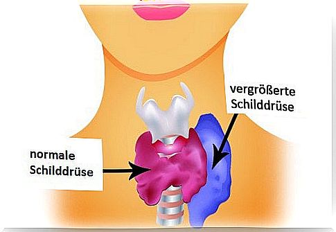 hyperthyroidism