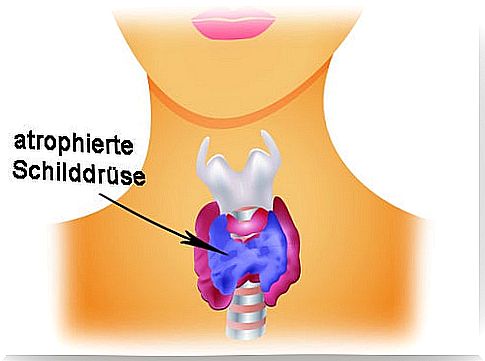 atrophied thyroid