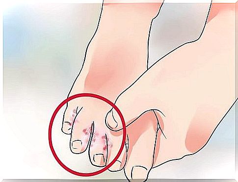 How to treat athlete's foot naturally