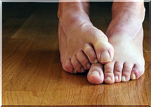 You can treat athlete's foot naturally with these remedies.