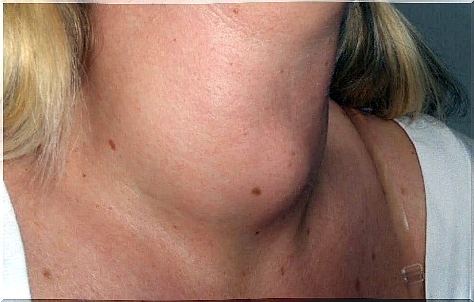 Lump on the neck