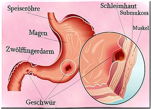 Gastric ulcer and right-sided abdominal pain