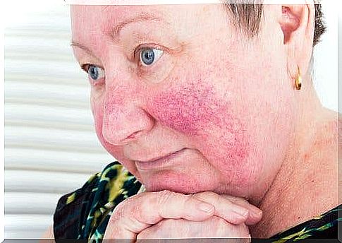 Rosacea manifests itself as visible blood capillaries on the surface of the skin