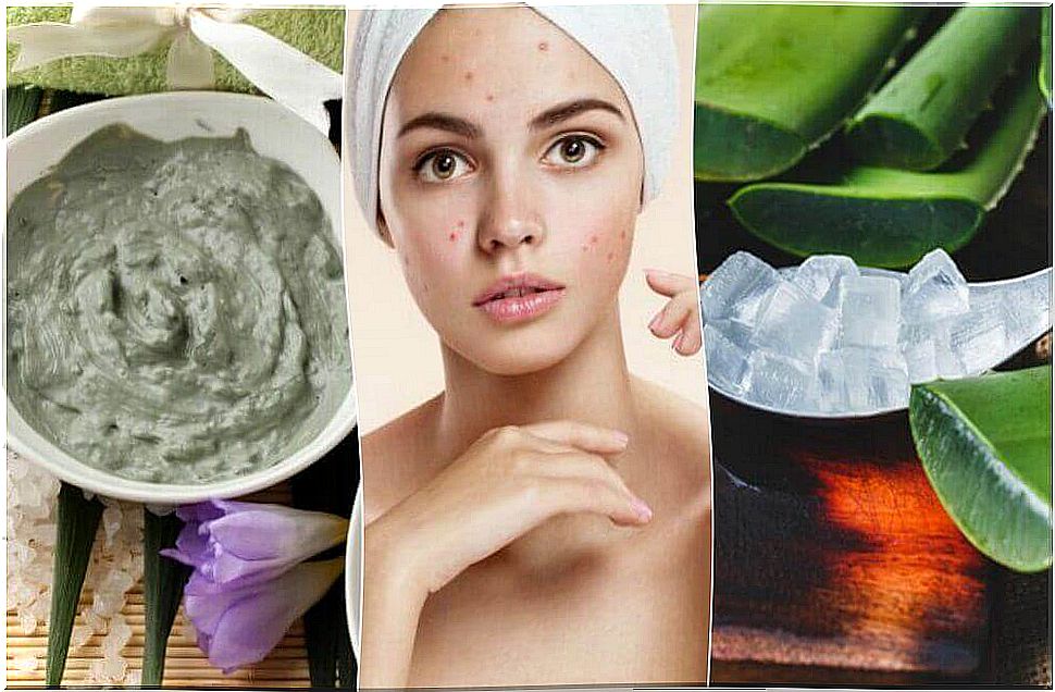 Treating Acne Naturally: 5 Tips