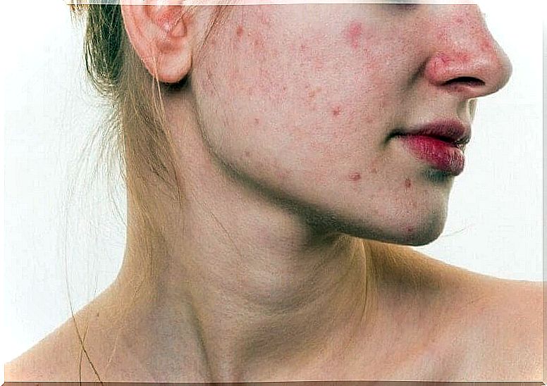 Treat acne naturally