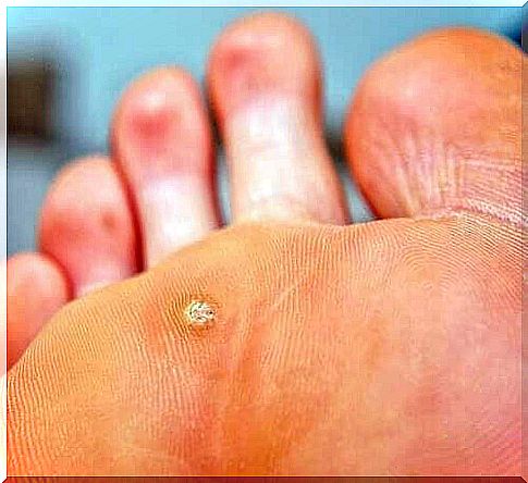 Treat plantar warts with apple cider vinegar and lemon