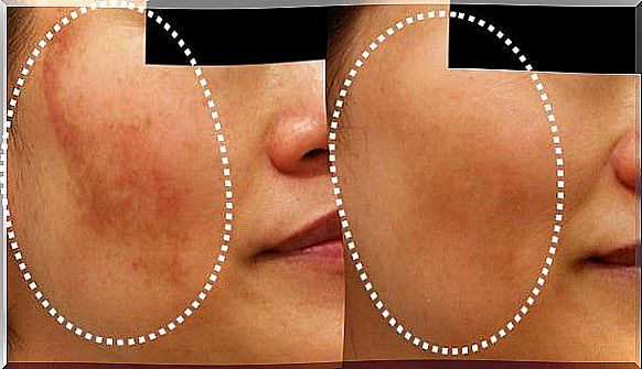 Treating melasma naturally