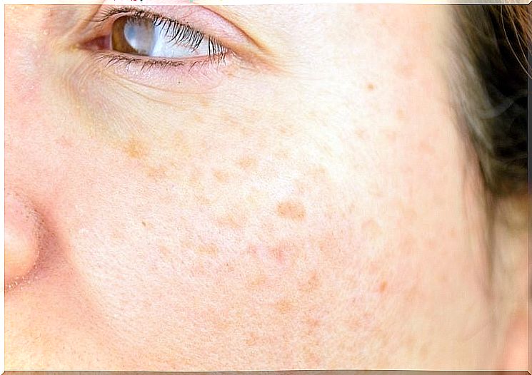 The most common skin problems: dark spots