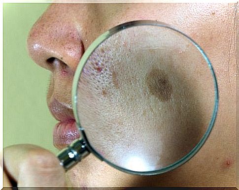 The most common skin problems: melasma