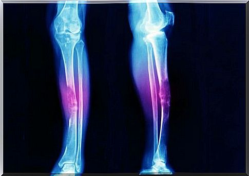 Types of sarcomas - lower leg x-ray