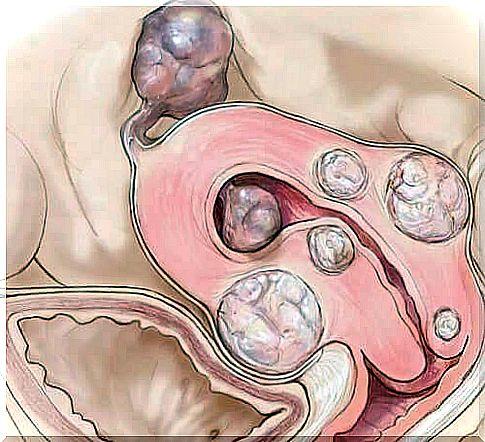 Uterine fibroids - Image