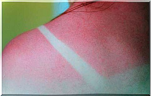 Sunburn is very harmful