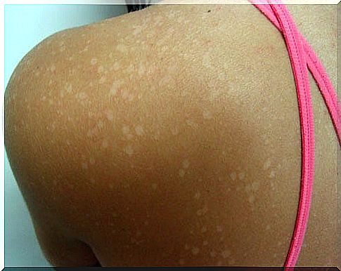 light patches of skin due to fungal infection